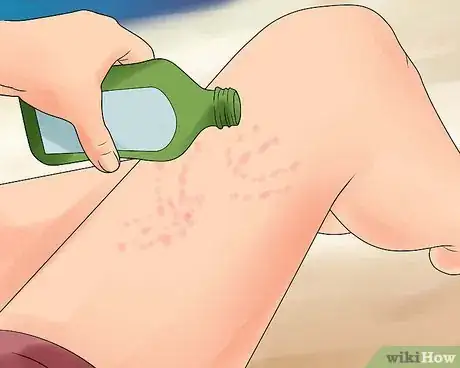 Imagen titulada Treat Jellyfish Stings Step 14