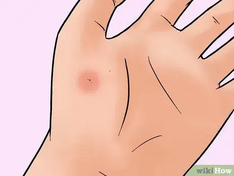 Imagen titulada Remove a Pin or Tack from Your Skin Step 9