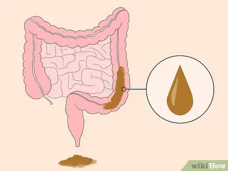 Imagen titulada Know If You Have Worms Step 10