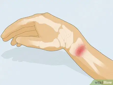 Imagen titulada Cope With a Broken Wrist Step 1