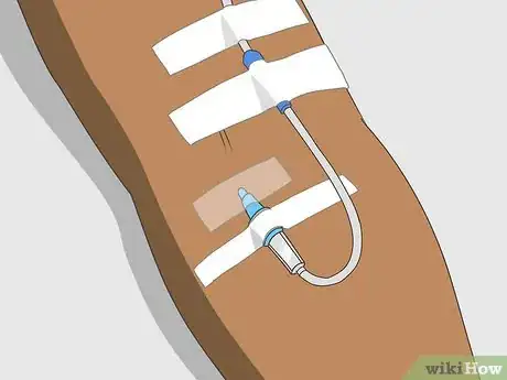 Imagen titulada Insert an IV Step 15