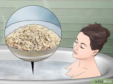 Imagen titulada Treat Flea Bites Step 7