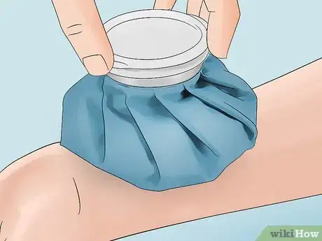 Imagen titulada Treat Flea Bites Step 5