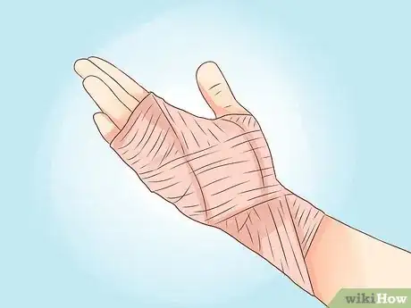 Imagen titulada Treat a Burn Using Honey Step 9