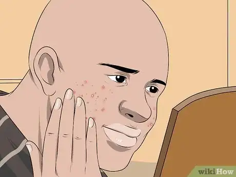 Imagen titulada Dry Out a Pimple Step 18