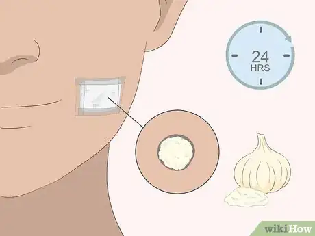 Imagen titulada Remove Moles Quickly Step 10