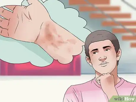Imagen titulada Reduce Bruising Step 11