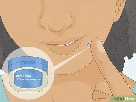 Imagen titulada Remove a Mole with Iodine Step 6