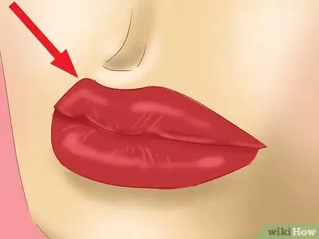 Imagen titulada Recognize Hives (Urticaria) Step 3