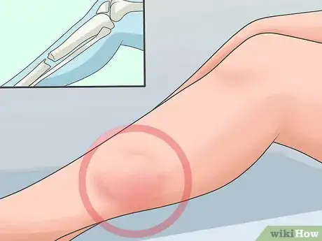 Imagen titulada Splint a Fracture of the Lower Leg Step 11