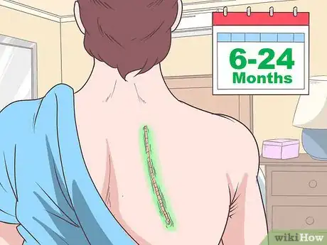 Imagen titulada Treat Winged Scapula Step 1