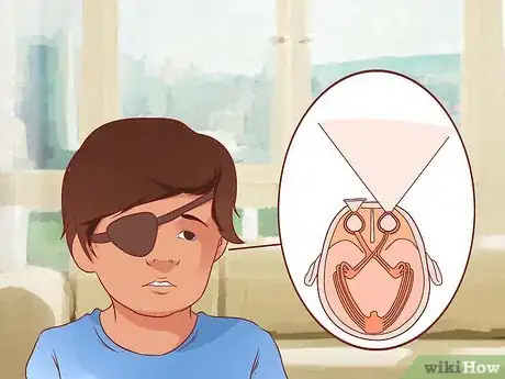 Imagen titulada Get Rid of a Lazy Eye Step 11