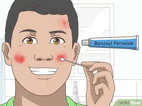 Imagen titulada Get Rid of Acne Cysts Fast Step 10