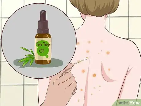 Imagen titulada Get Rid of Back Acne Fast Step 7