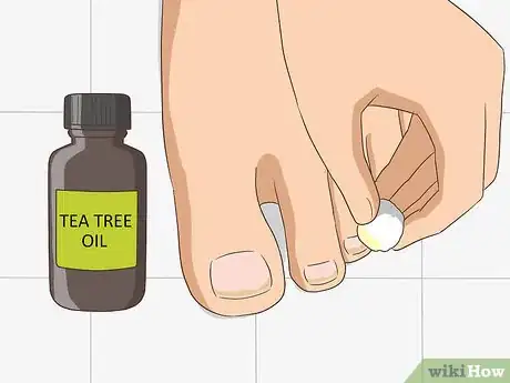 Imagen titulada Treat Toe Nail Fungus Step 6