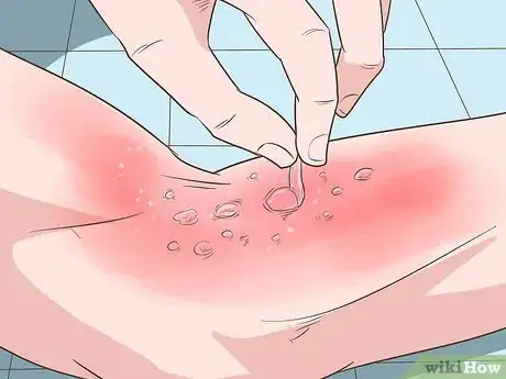 Imagen titulada Treat a Sunburn Step 19