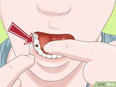 Imagen titulada Know if Your Dental Fillings Need Replacing Step 5