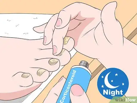 Imagen titulada Get Rid of Psoriasis on Your Nails Step 2