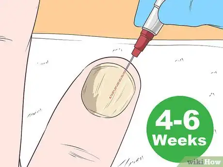 Imagen titulada Get Rid of Psoriasis on Your Nails Step 4