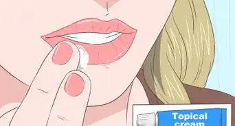 tratar el herpes labial