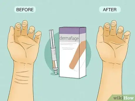 Imagen titulada Hide Self Harm Scars Step 2