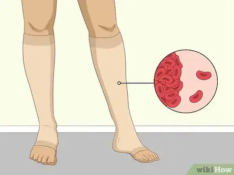 Imagen titulada Clear Blood Clots Naturally Step 7