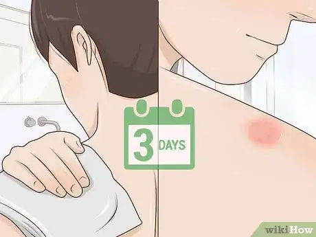 Imagen titulada Treat Boils at Home Step 5