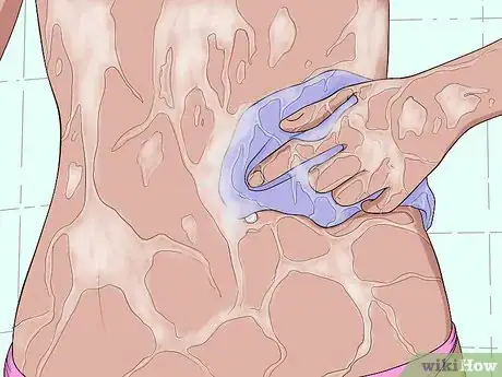 Imagen titulada Treat an Irritated Belly Button Piercing Step 2