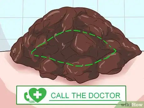 Imagen titulada Recognize Melanoma Step 8