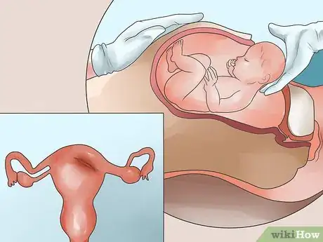 Imagen titulada Recognize Symptoms of a Postpartum Hemorrhage Step 3