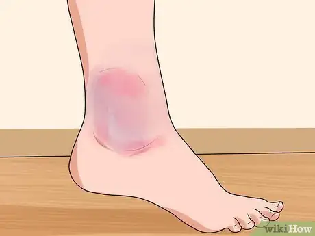 Imagen titulada Know if You've Sprained Your Ankle Step 3