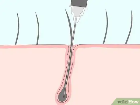 Imagen titulada Remove Armpit Hair Step 34