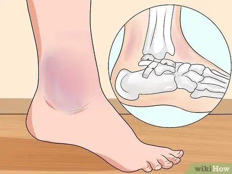 Imagen titulada Know if You've Sprained Your Ankle Step 6