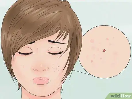 Imagen titulada Have an Acne Free Face Step 2