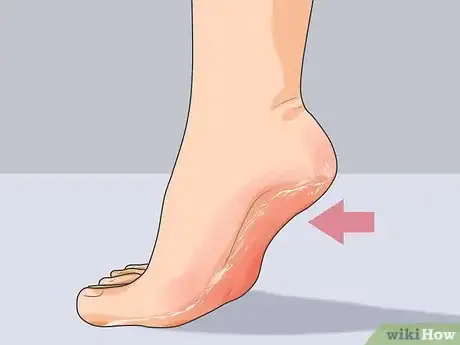 Imagen titulada Treat Athlete's Foot Step 5