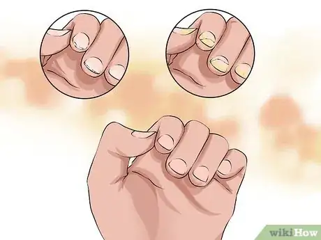 Imagen titulada Identify and Treat Ringworm Step 6