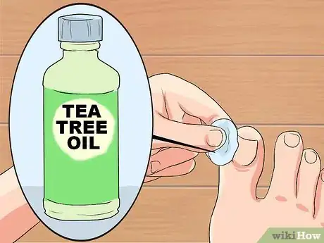Imagen titulada Cure an Infected Toe Step 7