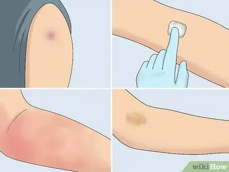Imagen titulada Inject Into a Vein Step 18