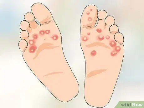 Imagen titulada Treat Athlete's Foot Step 6