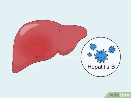 Imagen titulada Treat Liver Fibrosis Step 5