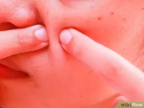 Imagen titulada Make a Blackhead Remover (Epsom Salts and Iodine Method) Step 6