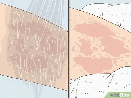 Imagen titulada Get Rid of a Rash Step 2