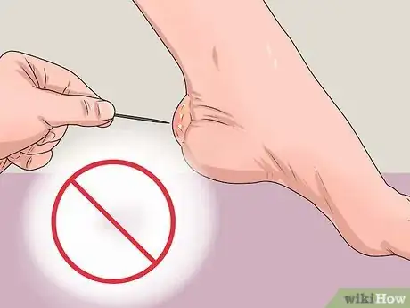 Imagen titulada Care for a Burst Blister Step 4