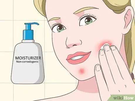 Imagen titulada Get Rid of Acne Cysts Fast Step 11