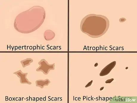 Imagen titulada Get Rid of Acne Cysts Fast Step 17