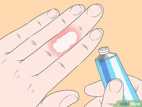 Imagen titulada Cure an Infected Finger Step 2
