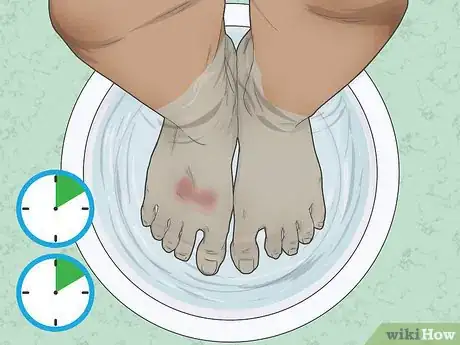 Imagen titulada Treat Wax Burns Step 1