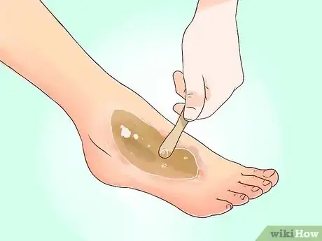 Imagen titulada Treat a Burn Using Honey Step 6