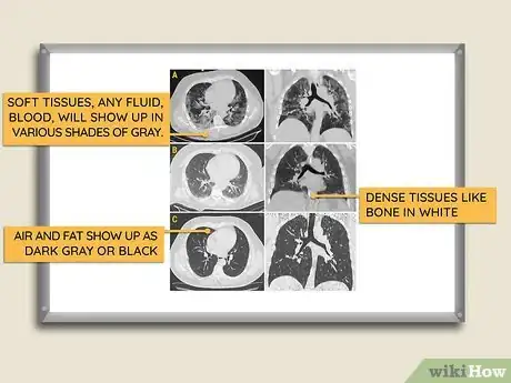 Imagen titulada Read a CT Scan Step 6