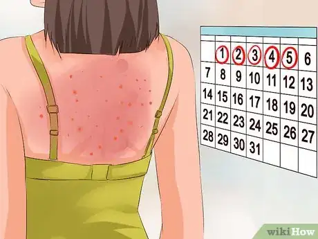 Imagen titulada Recognize Chickenpox Step 5